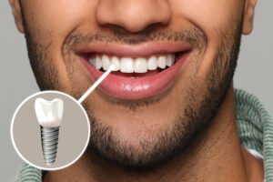 Happy man with perfect teeth smiling on grey background, closeup. Illustration of dental implant